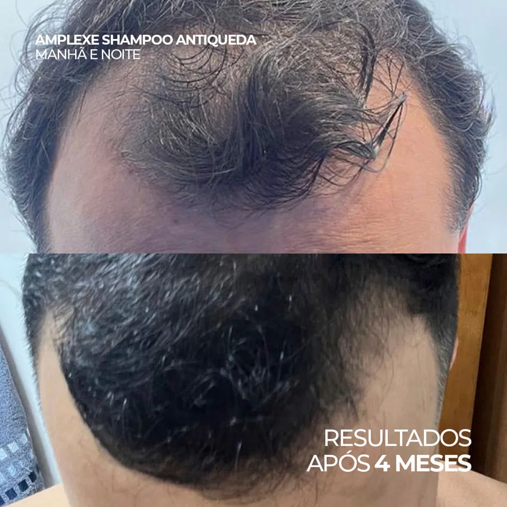 Kit Ada Tina Amplexe Shampoo 300ml e Loção Antiqueda
