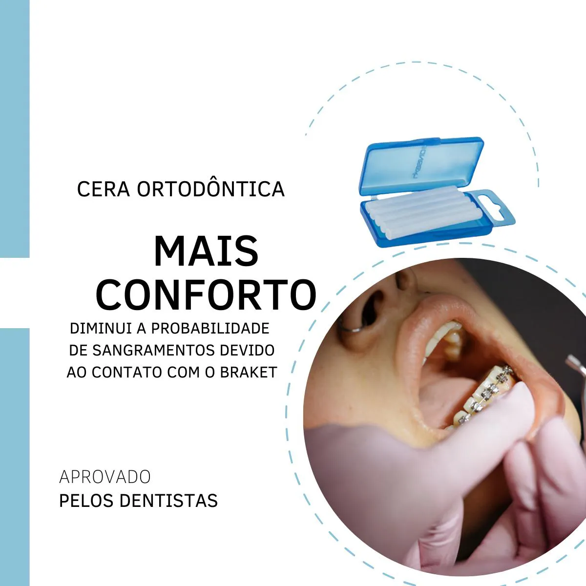Cera Ortodôntica para Aparelho Proteção Labios 50 Bastões